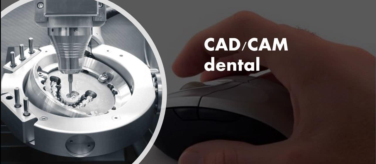 CAD CAM Prótesis Dental | Clínica Villacastín